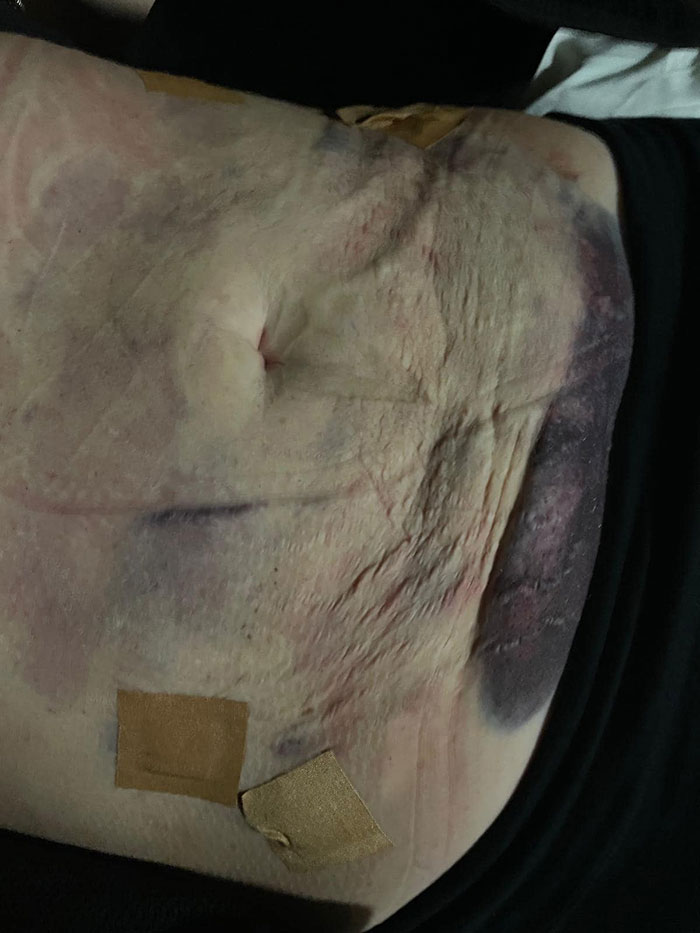 Woman Hospitalized After Liposuction Procedure Using AliExpress Dental Phlegm Suction Machine Woman Hospitalized After Liposuction Procedure Using AliExpress Dental Phlegm Suction Machine