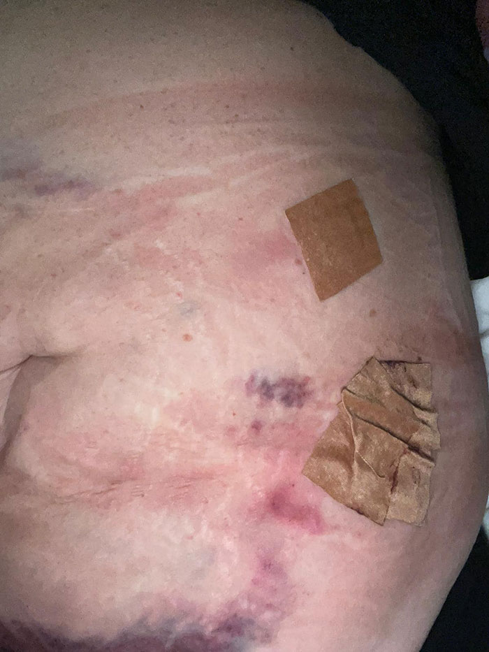 Woman Hospitalized After Liposuction Procedure Using AliExpress Dental Phlegm Suction Machine Woman Hospitalized After Liposuction Procedure Using AliExpress Dental Phlegm Suction Machine