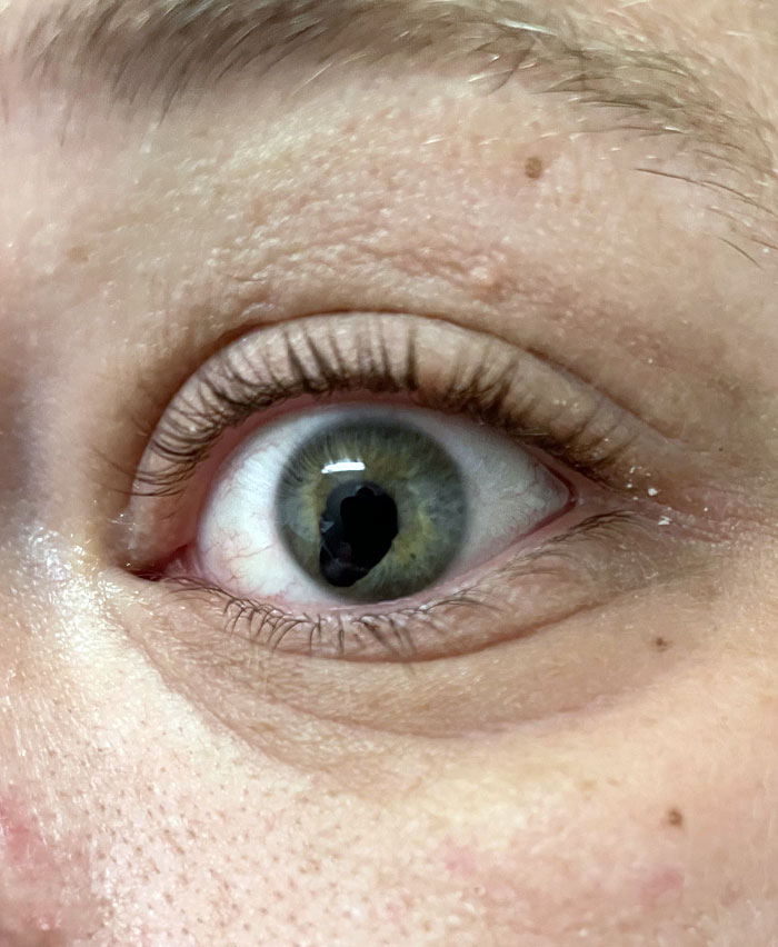Had A Nail Run Through My Eye. They Stretched My Pupil Over The Hole And Stitched It Up