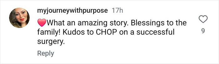 "So Grateful": Mom Of Successfully Separated Conjoined Twins Reveals They Went Home After A Year