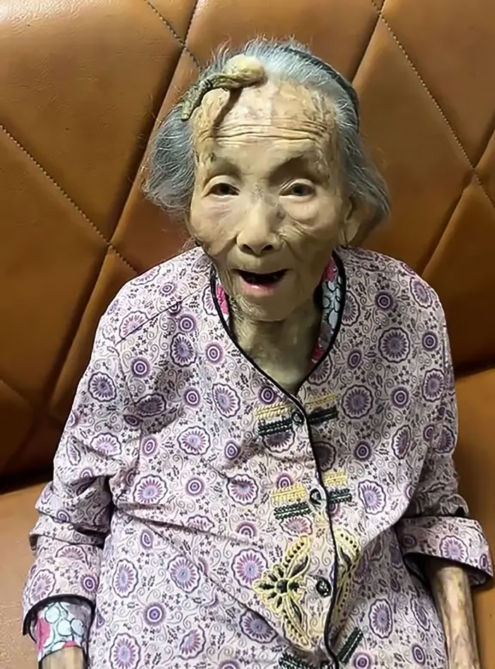 "It's Too Risky": 107YO Goes Viral For 4-Inch "Longevity Horn" Growing From Her Forehead "It's Too Risky": 107YO Goes Viral For 4-Inch "Longevity Horn" Growing From Her Forehead