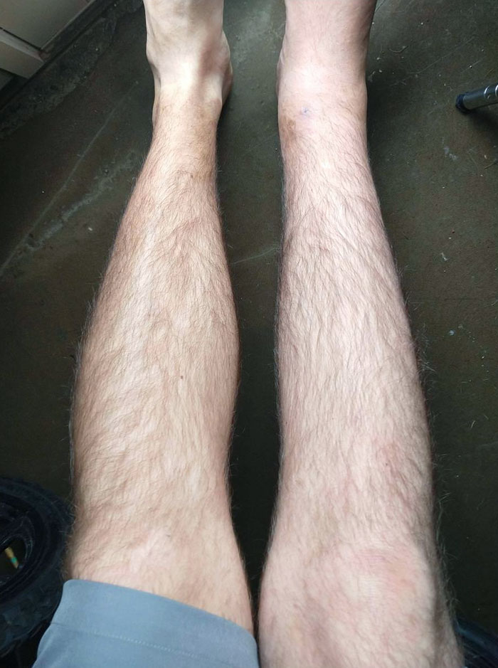 Size Difference In My Legs After An Injury And Putting No Weight On One For 3 Months