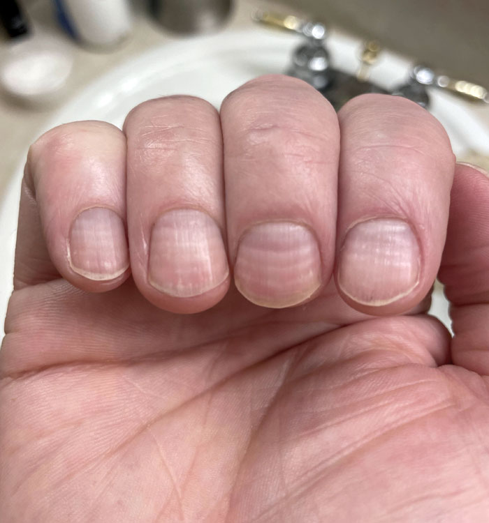 6 Lines On My Fingernails, One For Each Chemo Session I Had Recently