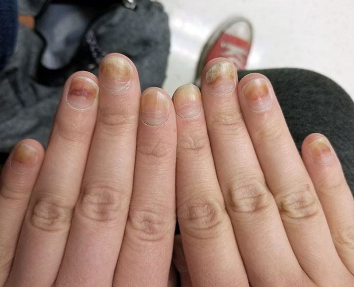 My Nails Pushing The Chemo Out Of My Fingertips