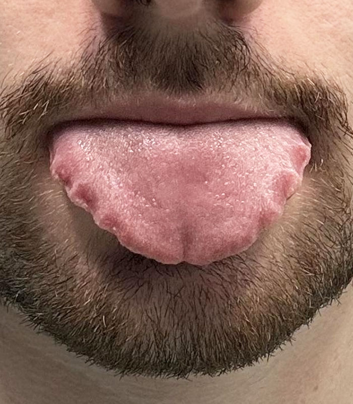 The Shape Of My Tongue Due To Wearing Retainers At Night