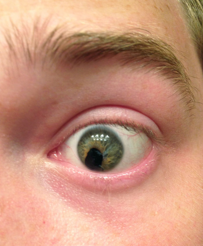 I Was Stabbed In The Eye With A Hanger 11 Years Ago