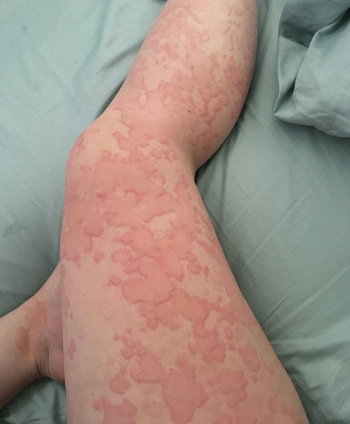 The Time I Got Gnarly Hives All Over My Body