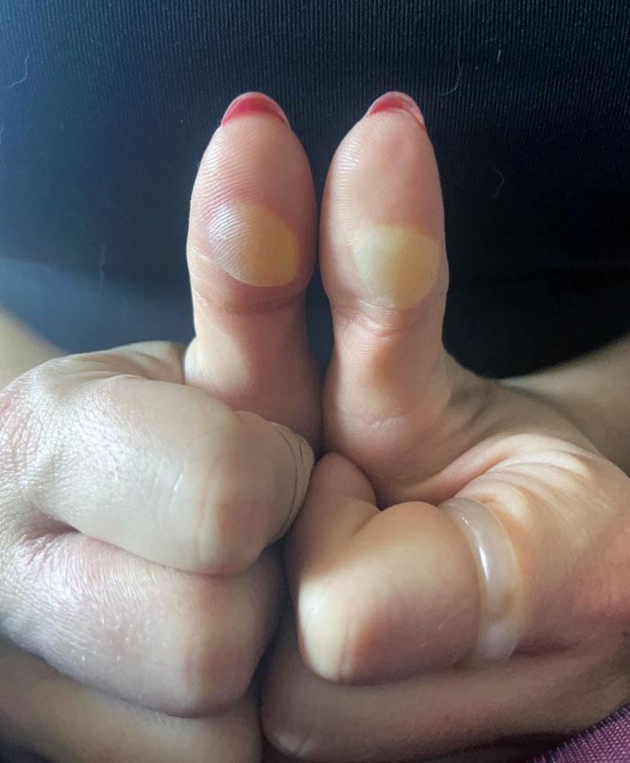 Left: Blister From A Candle Burn. Right: Blister From Frostbite 2 Days Later