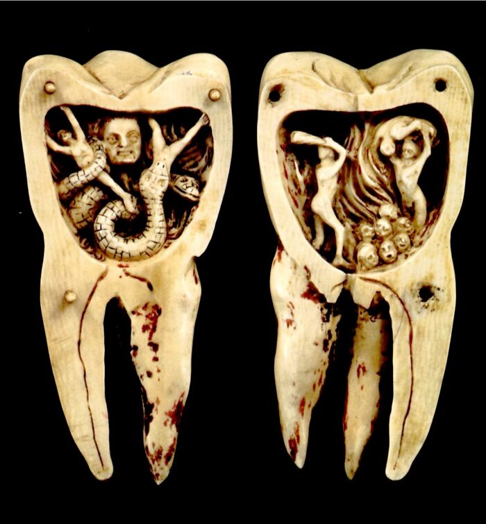 Esta ilustración es una representación del siglo XVIII de la antigua creencia de que los dolores de muelas eran causados por pequeñas criaturas demoníacas conocidas como «gusanos dentales».
