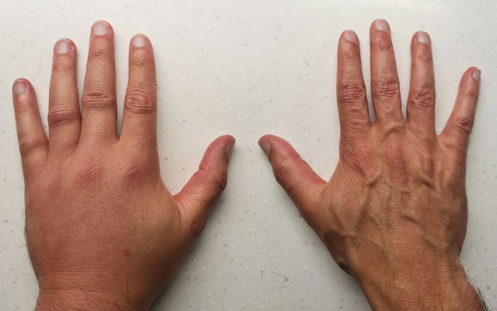 Swollen Left Hand After Insect Bite, Compared To 'Normal' Right Hand