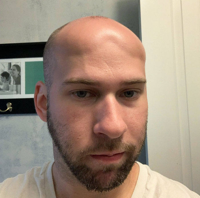 My Husband Got Scalp Edema From A Severe Sunburn