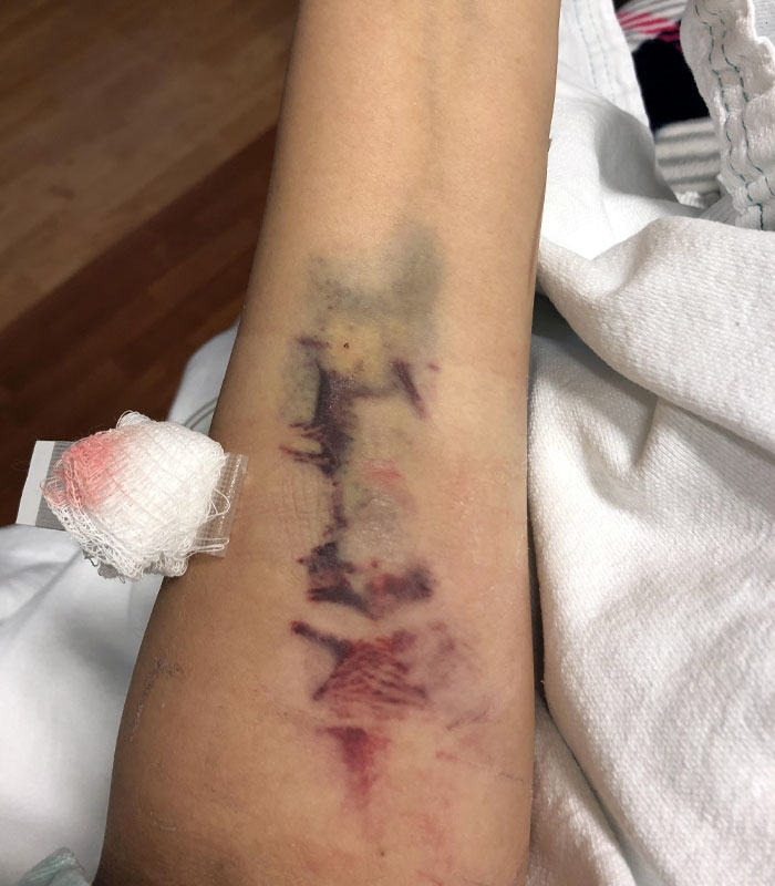 The Bruises On My Arm After Nurses Couldn’t Find A Vein
