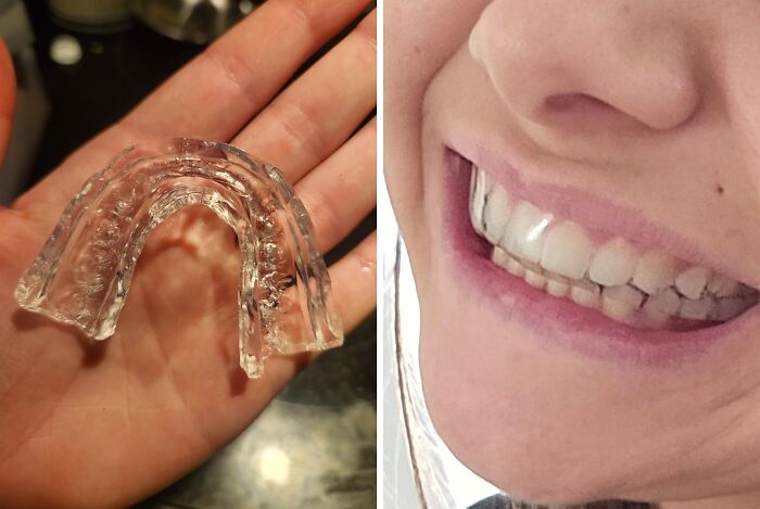 "Grinding Your Teeth Like A Dj Scratching A Record? This Moldable Dental Guard Will Keep Your Pearly Whites Safe And Sound