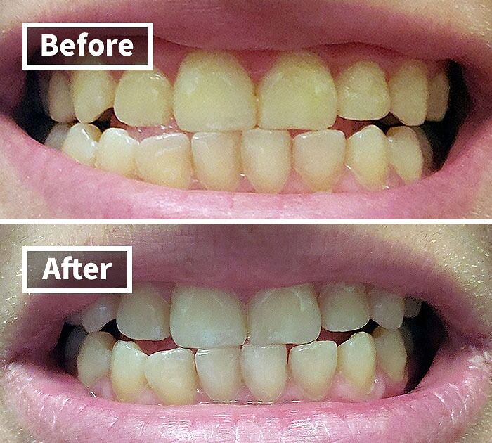 Brighten Your Smile In A Flash With The Venus Visage Teeth Whitening Pen, A Convenient, Portable Powerhouse That Whitens And Shine Teeth With Just A Few Easy Applications