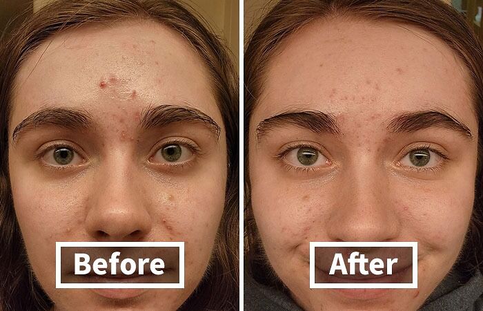 Harness The Natural Power Of Sulfur To Tackle Acne And Breakouts With The Sulfur Soap For Acne, A Gentle Yet Effective Cleanser That Purifies Pores And Calms Troubled Skin