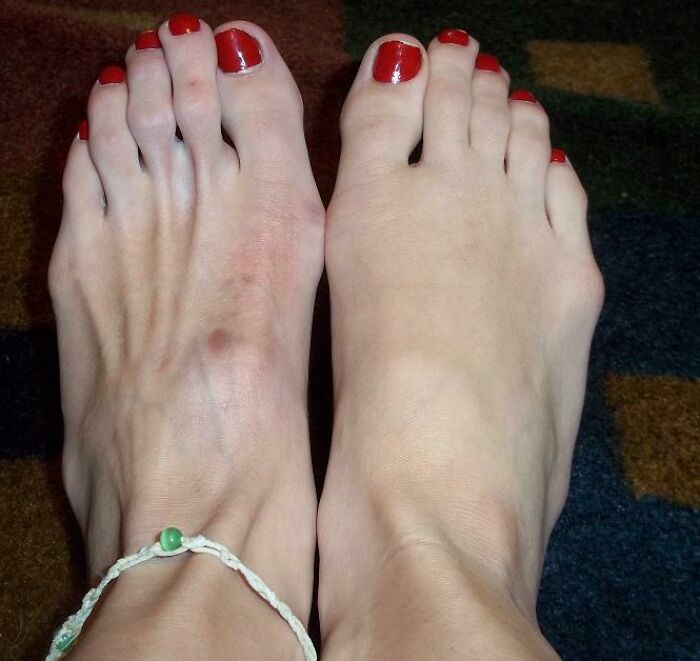 This Is My Atrophied Foot After A Soccer Injury That Shredded My Nerves Apart