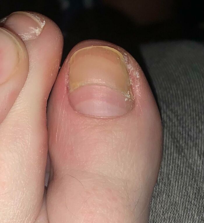 My Toenail Grew In Extra Thick During My Pregnancy Then Abruptly Stopped Growing Thick Once I Gave Birth To My Son