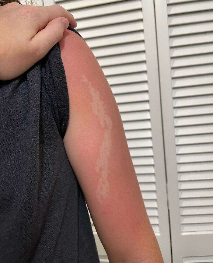 This Patch On My Skin Never Tans/Burns. I’ve Had It Since I Was Born!