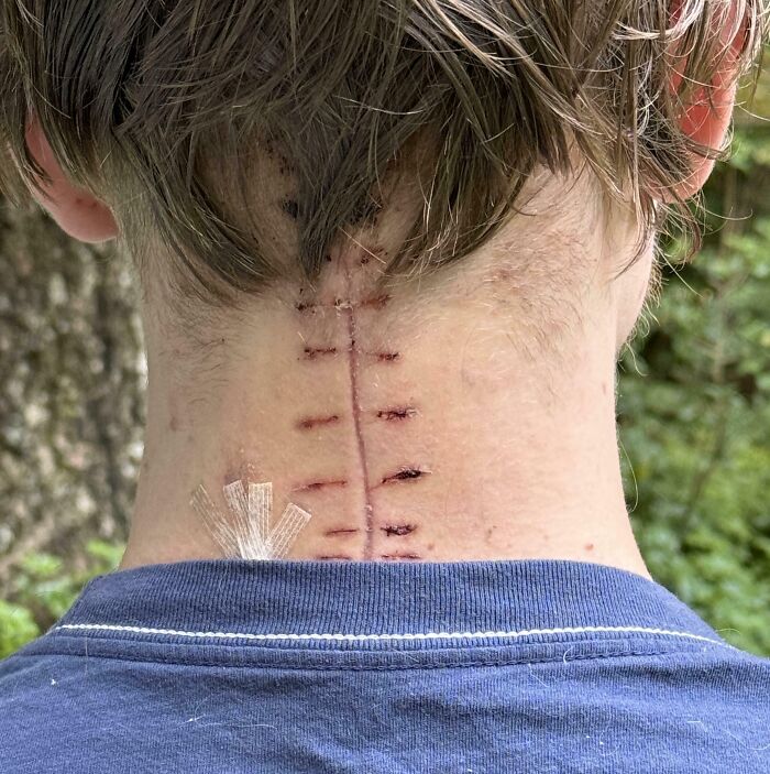 Cervical Fusion Surgery Scar 2 Weeks Post Op