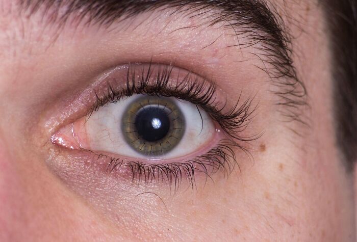 My Cornea Transplant Nearly 4 Months After Surgery