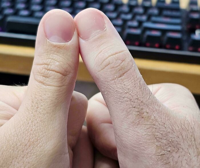 My Right Thumb Which Was Under A Cast For A Month Has Become Much Hairier Than My Left