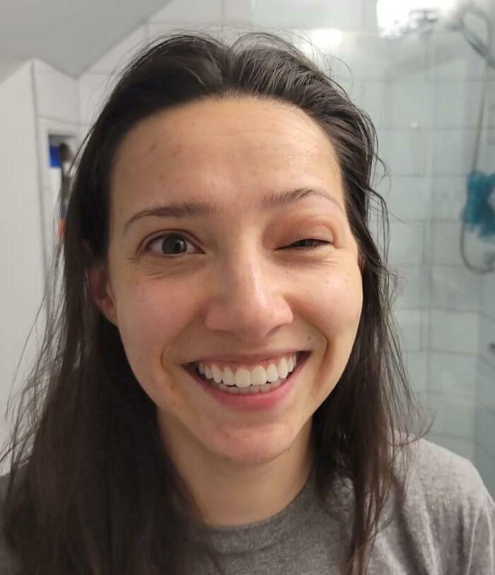 My Histamine Response After Spider Bite On Eyelid