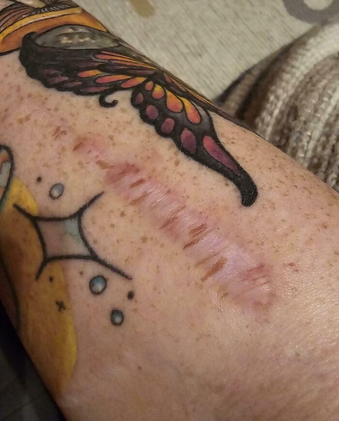 'stretched' Freckles On My Surgery Scar