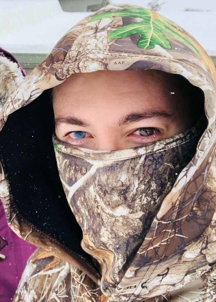 Something Interesting : I Got An Eye Injury 6 Years Ago That Left My Right Eye Blue Now Instead Of The Original Brown!