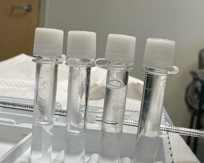 Neurologist Let Me Take A Picture Of My Spinal Fluid After My Lumbar Puncture Procedure