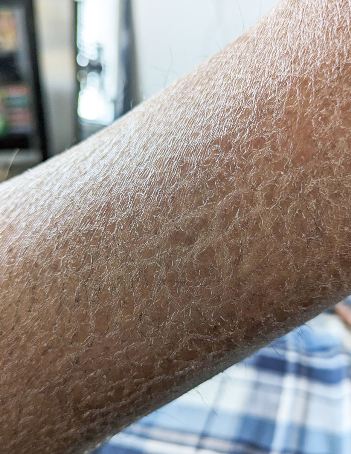 My Skin Was So Dry It Made Patterns