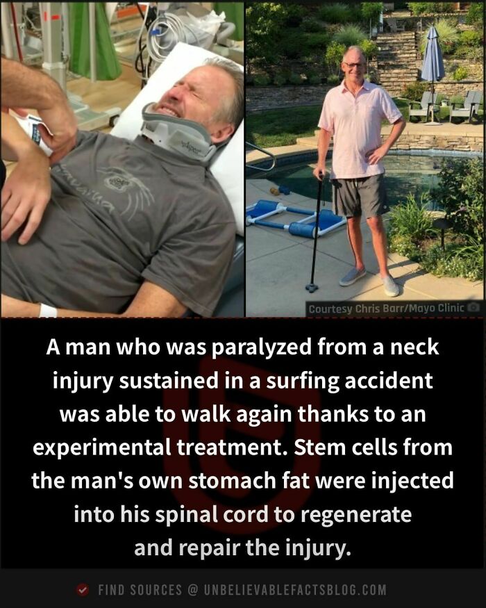 Man recovering from paralysis after experimental stem cell treatment from stomach fat injection.