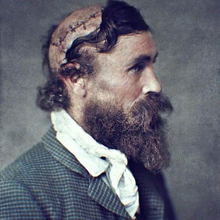 Robert Mcgee, Scalped At The Age Of 14 In 1864