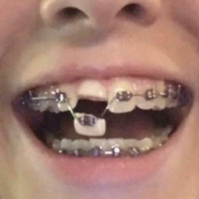 Close-up of a smiling mouth with braces on teeth, showing a dark and bizarre reality twist in dental alignment.