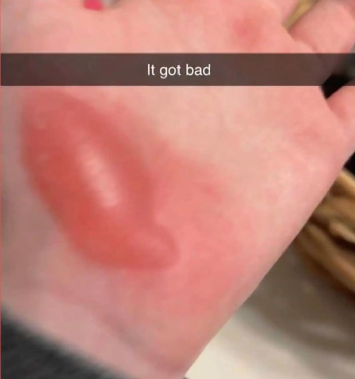 Outrage Erupts As Texas Cheerleaders Suffer Burns From Coach’s “Barbaric” Punishment Outrage Erupts As Texas Cheerleaders Suffer Burns From Coach’s “Barbaric” Punishment