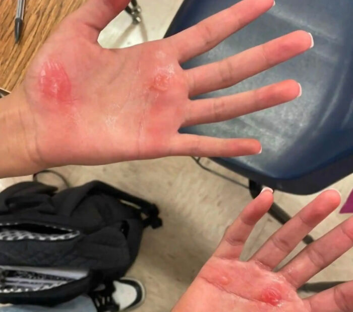 Outrage Erupts As Texas Cheerleaders Suffer Burns From Coach’s “Barbaric” Punishment Outrage Erupts As Texas Cheerleaders Suffer Burns From Coach’s “Barbaric” Punishment