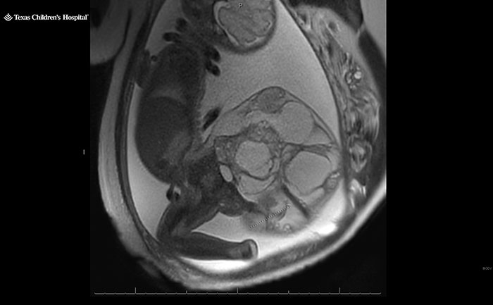 "Miracle Angel": Newborn Survives Life-Threatening 4-Lb. Tumor, Mom Candidly Shares Her Story "Miracle Angel": Newborn Survives Life-Threatening 4-Lb. Tumor, Mom Candidly Shares Her Story