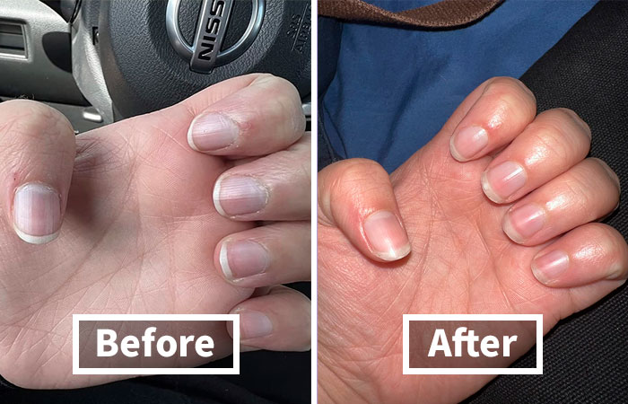 Before and after images of fingernails, showing beauty solutions for winter woes with improved nail condition.