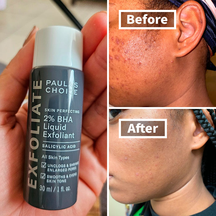 "Started using retinol right before visiting my boyfriend’s family and I’m purging like a motherf***er" - serketboard