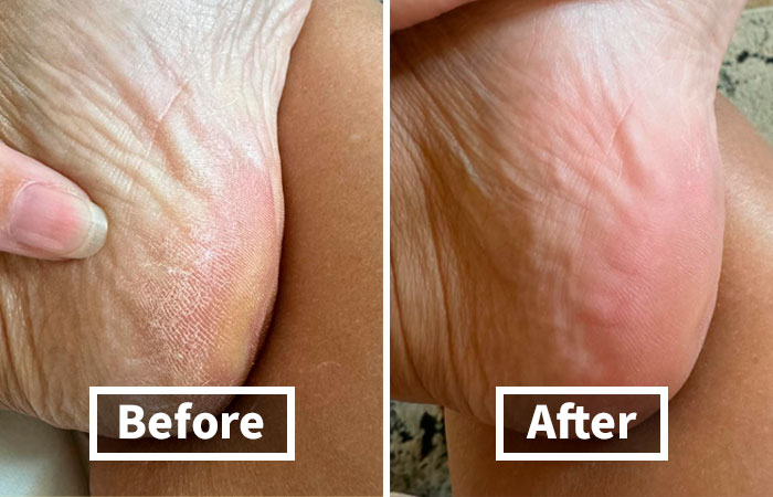 Before and after images showing foot skin improvement, addressing winter beauty woes.