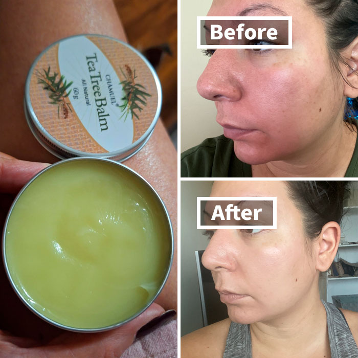 Tea tree balm before and after results for winter beauty woes.