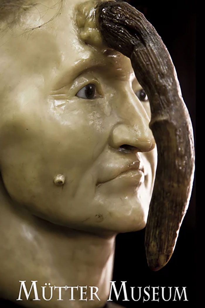 "It's Too Risky": 107YO Goes Viral For 4-Inch "Longevity Horn" Growing From Her Forehead "It's Too Risky": 107YO Goes Viral For 4-Inch "Longevity Horn" Growing From Her Forehead