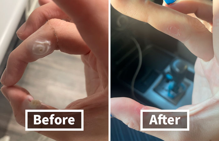 Discreetly Ditch Unwanted Warts With This Effective Compound W Wart Remover