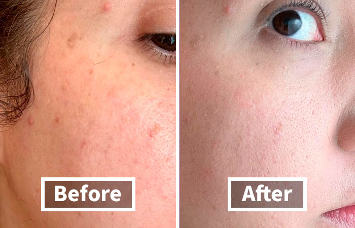 Before and after skincare results for winter beauty woes, highlighting clear skin improvement.