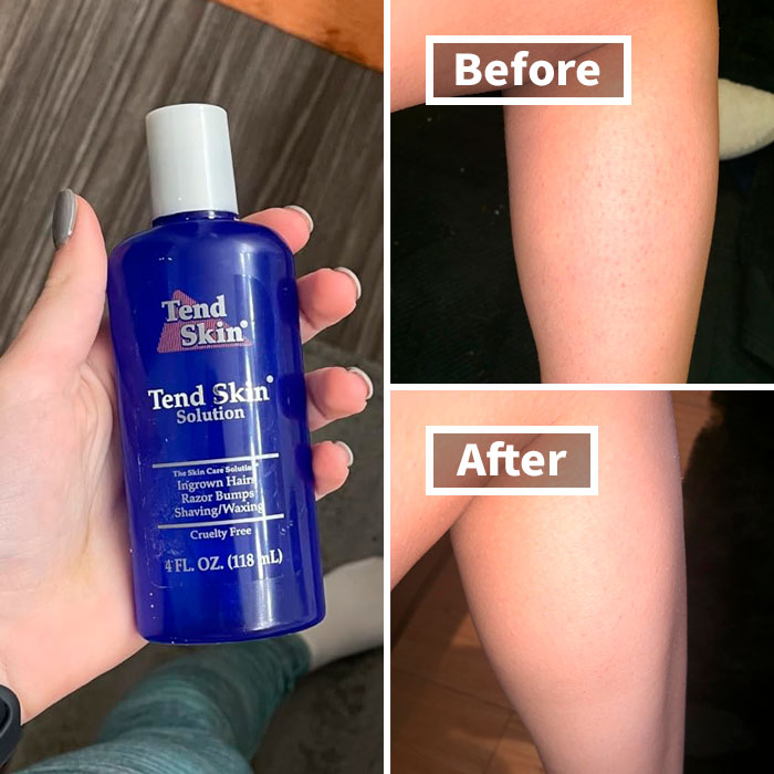 ""Can't remember if it was hair removal cream or bleach, but whatever it was I put it on my upper lip, my skin didn't like it at all, and I had a rashy moustache for about two weeks after." - ellef86