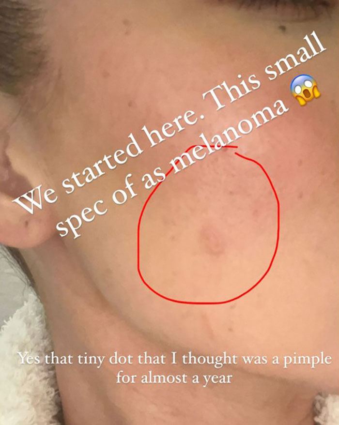 Khloé Kardashian Shares Before-and-After Pics of Facial Injections After Removing Tumor From Cheek Khloé Kardashian Shares Before-and-After Pics of Facial Injections After Removing Tumor From Cheek