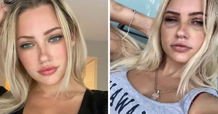 “Psycho” Plastic Surgeon Allegedly Used Ex As Slave, Forcibly Injected Fillers Without Anesthesia