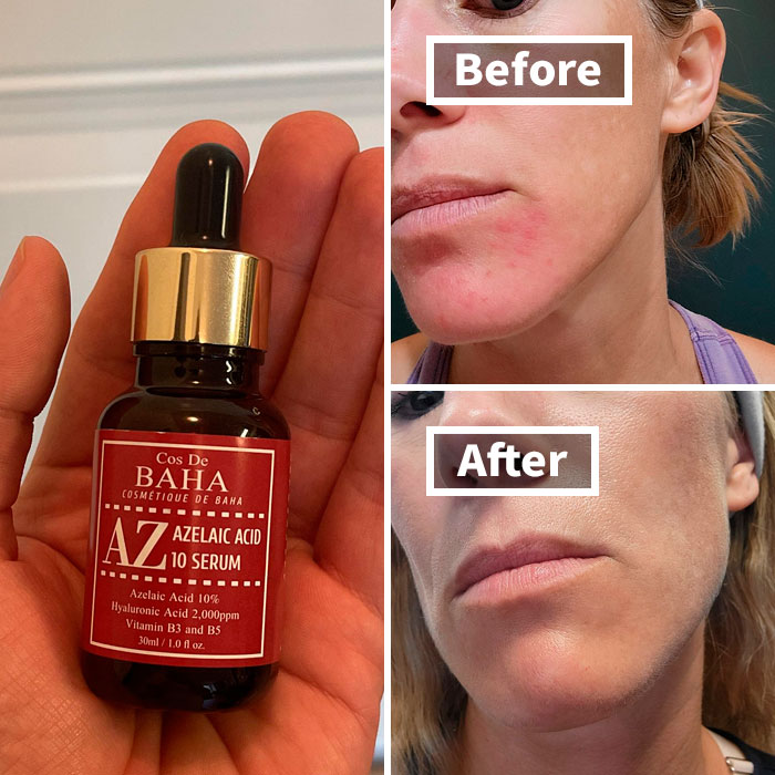 "Vitamin C drops caused my skin to itch horrendously" - messikah