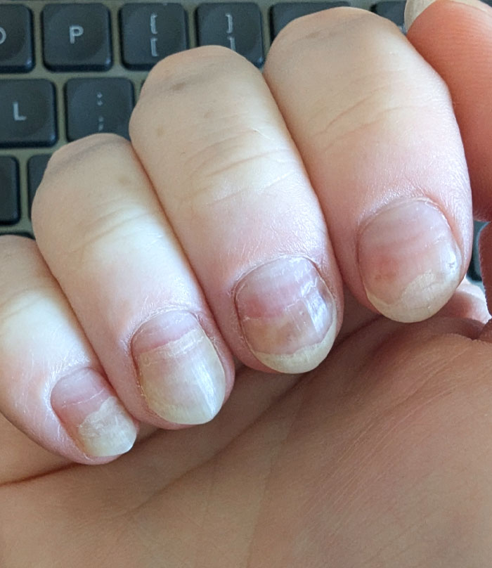 Nail Damage From Chemotherapy