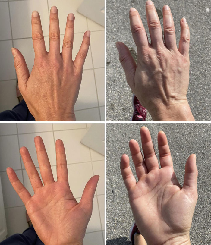 My Fingers Get Very Swollen When I Exercise