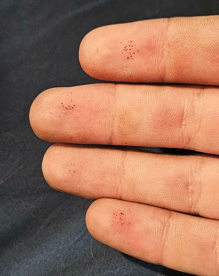 Engine Grease Revealing Where I Prick My Fingers To Check Blood Sugar